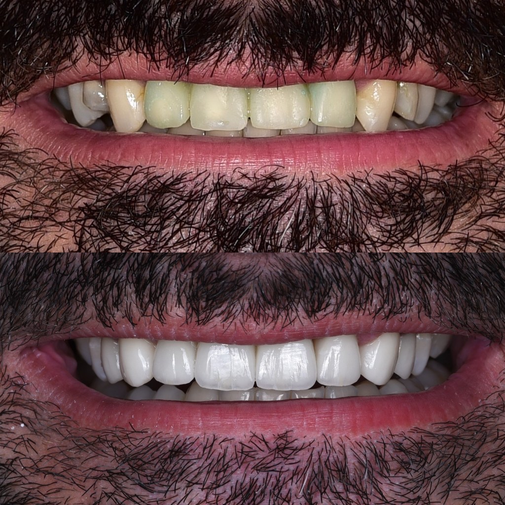 Coroane dentare Emax