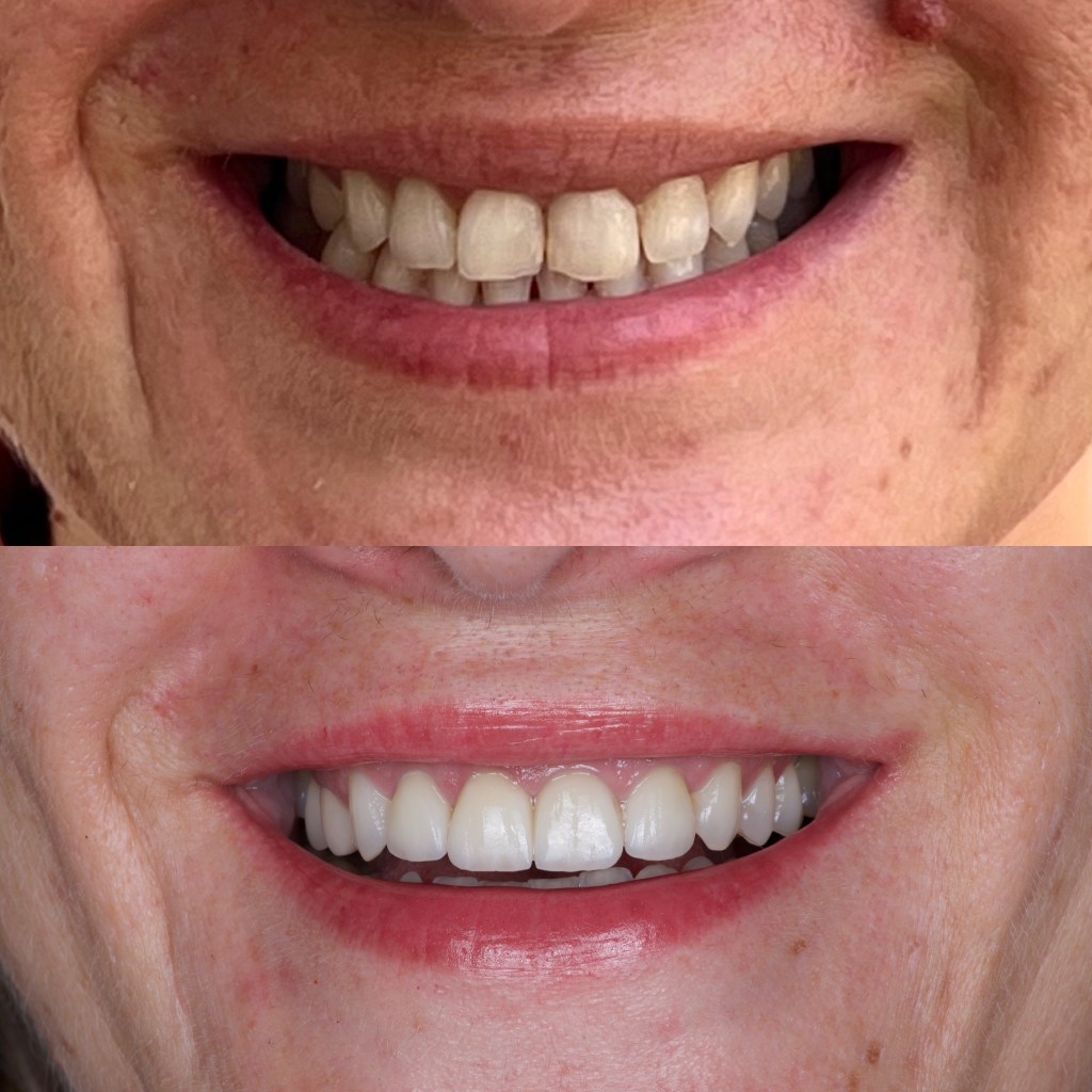 Caz fatete dentare&nbsp;Emax