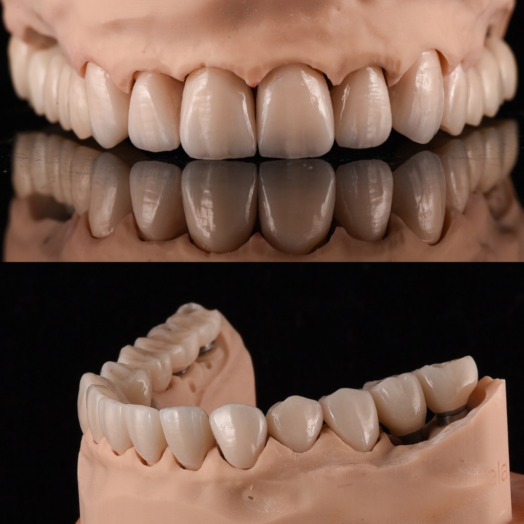 coroane dentare premium