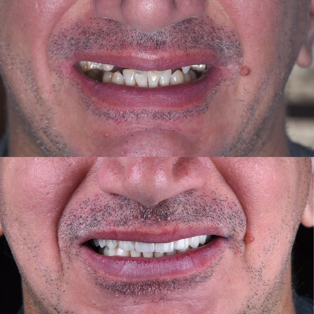 Reabilitare orala totala